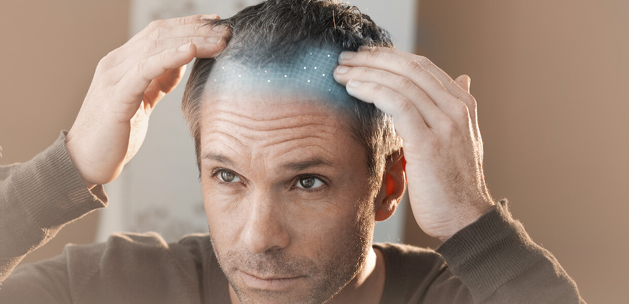 Cellular Therapy Era in Hair Loss Treatment and Hair Transplantation 